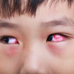 Causes and Symptoms of Pink Eye