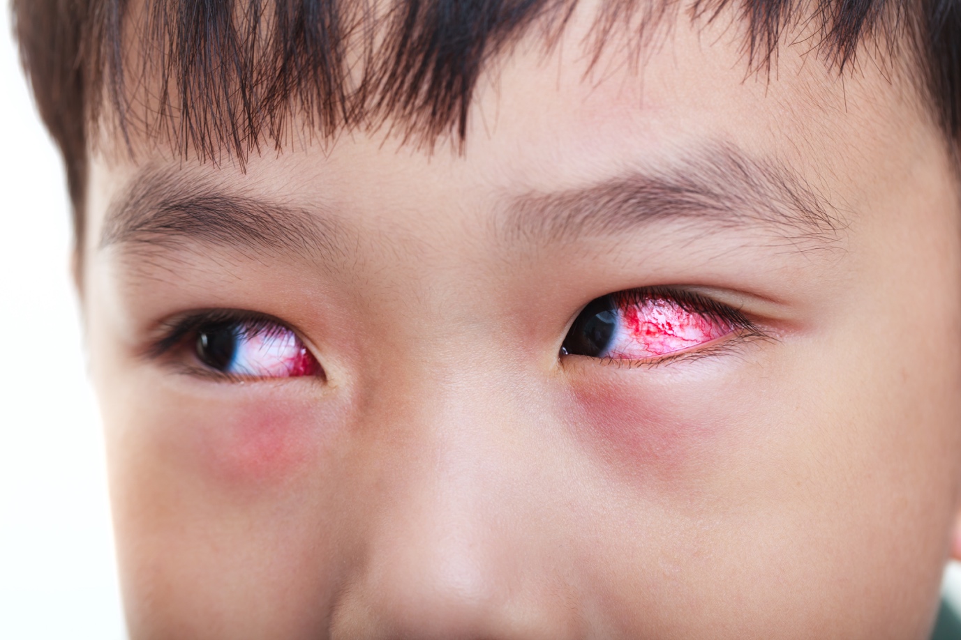what are the symptoms of pink eye