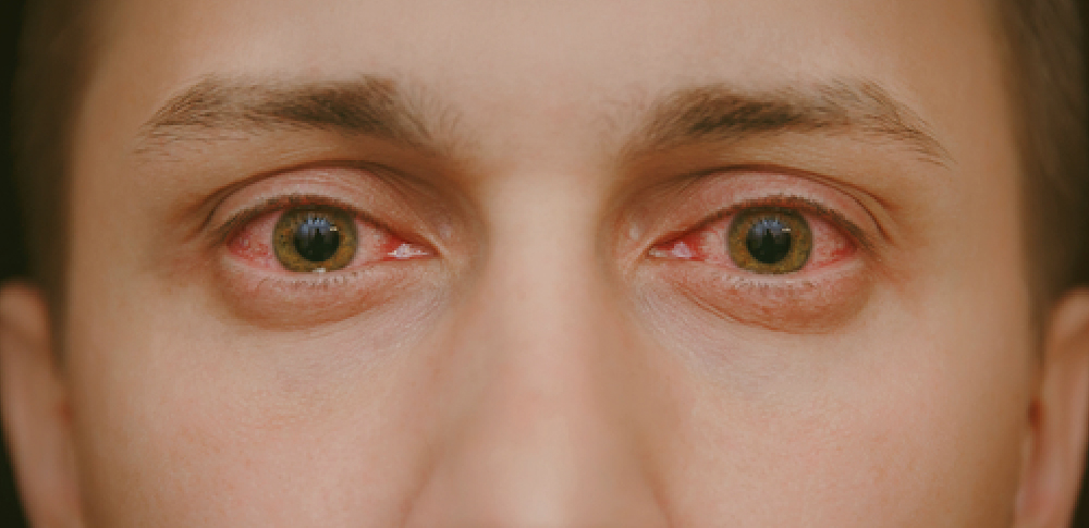 Get online treatment for pink eye infection today.