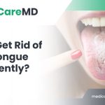 How to Get Rid of White Tongue Permanently