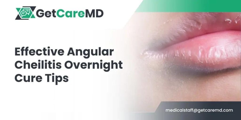 understanding-angular-cheilitis